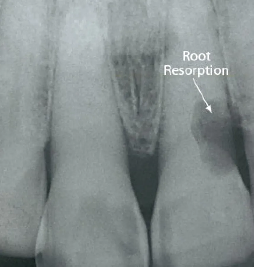 Root Resorption in Adult Teeth is a Cause for Concern