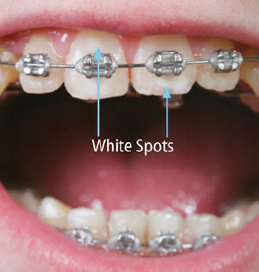 Effective Hygiene is Key to Preventing Enamel White Spots While Wearing Braces