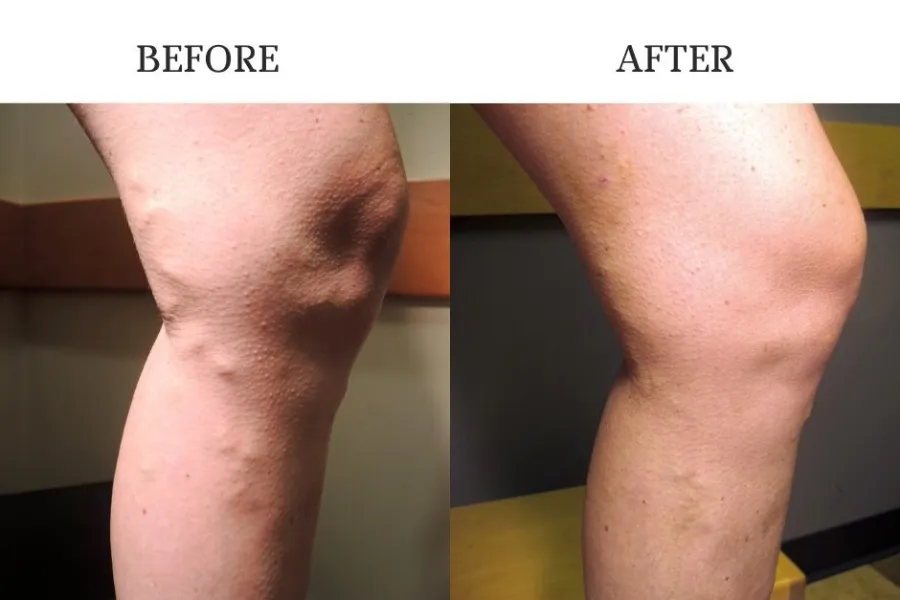 Before and after close-up of a leg showing reduced varicose veins and smoother skin texture.