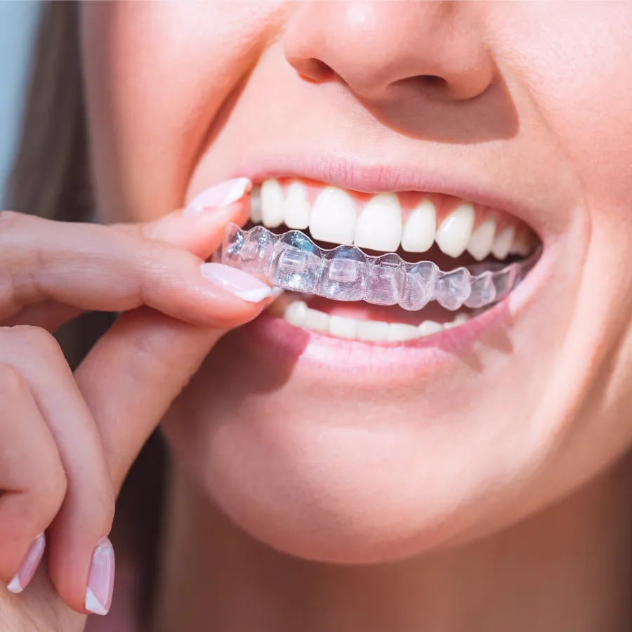 Close-up of a person inserting a clear dental aligner over their upper teeth for orthodontic treatment.