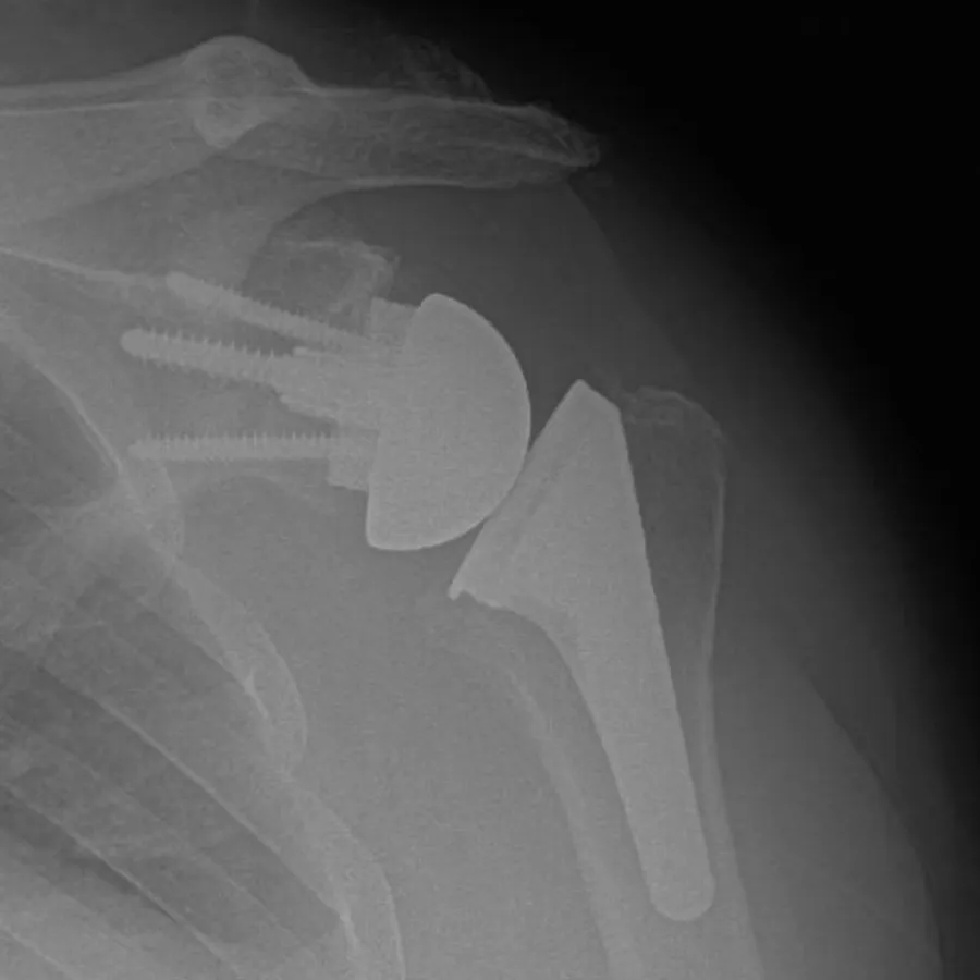X-ray showing shoulder joint replacement with metal prosthesis and screws in humerus bone.
