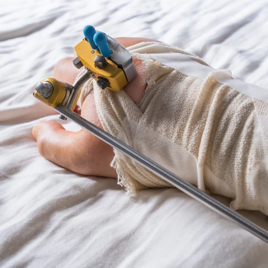 Close-up of a leg in an external fixation cast resting on a bed with visible metal rods and clamps.