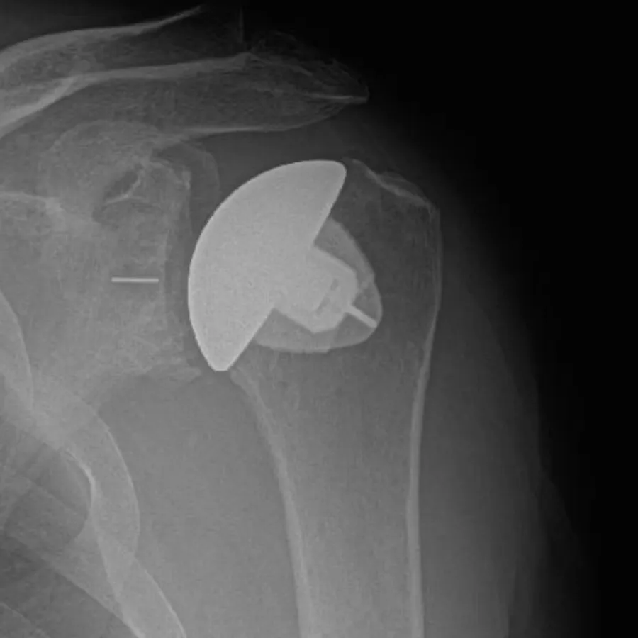 X-ray of shoulder showing a partial shoulder joint replacement implant inside the bone.