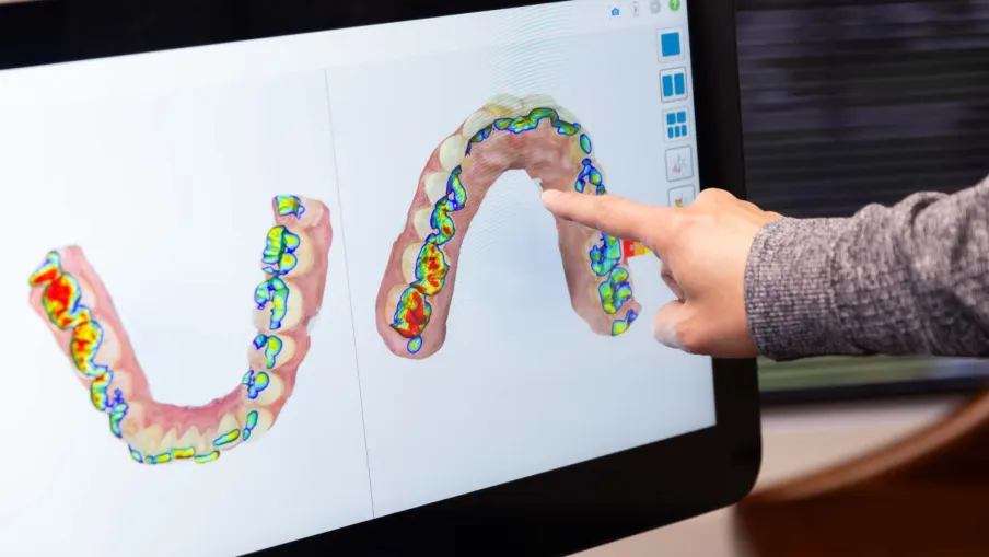 Person pointing at digital 3D dental scan on iTero screen showing detailed tooth surface analysis.