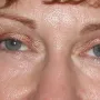 After Room for eyeshadow!  Upper blepharoplasty and laser resurfacing open these eyes and tigthten the lower eyelid skin. thumbnail