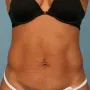 After This woman has had prior pregnancies, but wanted a smaller abdominal contour.  She had 6 cycles of CoolSculpting for her abdomen and waist.  thumbnail
