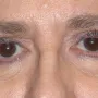After Upper blepharoplasty surgery was done by Dr. Kavali to remove extra skin and fat from the eyelids.  A browlift would complete this transformation and lift the eyes even more. thumbnail