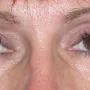 After This woman was concerned about heavy upper eyelids and underwent an upper blepharoplasty with Dr. Kavali to remove the extra skin. thumbnail