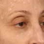 After Botox softens lines caused my muscle movement and can brighten a face by removing shadows caused by lines and creases.  Botox was used here between the brows and for the crows' feet (smile lines). thumbnail