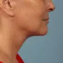 After This woman met her goals with Dr. Kavali by having a facelift with necklift to tighten her jawline and neck. thumbnail