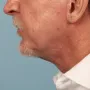 After A more defined jawline and lower face and neck in a male who chose Dr. Kavali for his facelift and necklift. thumbnail