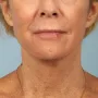 After This woman underwent a facelift and necklift using a high SMAS lift technique.  She also had a chemical peel done at the same time (a TCA peel) to brighten her skin.  She is shown about 6 months after surgery. thumbnail