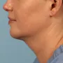 After Results after 2 Kybella Treatments thumbnail