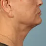 After Results after 2 Kybella treatments thumbnail