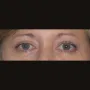 After This 50 year old female had upper blepharoplasty to remove extra fat and skin in the upper eyelids.  Her surgery was done in the office under local anesthesia. thumbnail