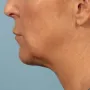 After This 58 year old Atlanta woman chose Kybella with Dr. Kavali to reduce the fullness in her neck.  Her results are shown 6 months after 3 Kybella treatments. She is thrilled with her results! thumbnail