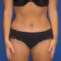After This Georgia mom had an abdominoplasty (tummy tuck) to remove loose skin and tighten her tummy muscles. She also had liposuction of her waist at the same time.  She is shown about 1 year after surgery. thumbnail