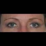 After This 50 year old female wanted a more “open” look to her eyes.  She had an upper blepharoplasty to remove excess skin and fat from her upper eyelids.  Her “after” photos were taken about 1 year after surgery. thumbnail