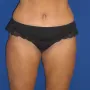 After This woman had an abdominoplasty (tummy  tuck) at the same time as liposuction of her hips, waist, and inner and outer thighs. thumbnail