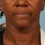 After This Atlanta woman had a facelift using a SMAS lift technique that lifts and tighten the lower face, jawline, and neck.  She is shown about 6 months after her outpatient surgery was done. thumbnail