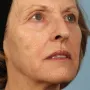 After This 68 year old Atlanta woman had a consultation with Dr. Kavali for facial rejuvenation.  Together, they decided that a variety of fillers would be best.  She had 4 syringes of Voluma in her cheeks, a syringe of Restylane Silk in her lips and around her mouth for the fine lines, and a syringe of Juvederm Ultra Plus in the nasolabial folds (smile lines). She is shown about 2 weeks after her treatment was done. thumbnail