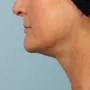 After Neck contouring by Dr. Kavali.  This woman had a facelift with necklift to meet her goals. thumbnail