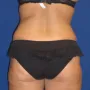 After This Georgia mom had an abdominoplasty (tummy tuck) to remove loose skin and tighten her tummy muscles. She also had liposuction of her waist at the same time.  She is shown about 1 year after surgery. thumbnail