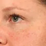 After After 1 syringe of Juvederm Vollure and 1 syringe of Juvederm Ultra to correct undereye hollows thumbnail