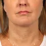 After A facelift and a TCA peel were used in combination to give this Atlanta woman a brighter, tighter look. thumbnail