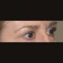 After This 61 year old female had upper eyelid contouring (blepharoplasty) to remove extra fat and skin from her upper eyelids. thumbnail