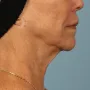 After Ulthera results: note the slimmer neck and tighter jawline. thumbnail