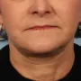 After This woman is shown about 6 months after her facelift and necklift with Dr. Kavali. thumbnail