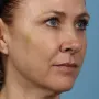 After This 50 year-old Atlanta woman chose Voluma to restore the youthful curves in her cheeks.  Her “after” photos are taken about 1 week after the treatment was done.  The goal is to give a subtle “lift” to the cheeks, which also improves the under-eye area. thumbnail