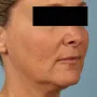 After This 52 year-old Atlanta woman wanted a more youthful contour to her face, as well as smoother lines and brighter skin.  She has eMatrix sublative skin treatments, and she had 3 syringes of Voluma in her cheeks, and one syringe of Juvederm Ultra Plus in her nasolabial folds (smile lines). thumbnail
