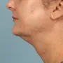 After Results after 3 Kybella Treatments thumbnail