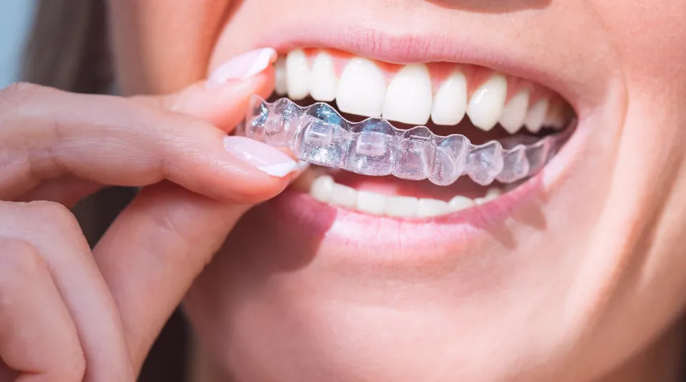Close-up of a person inserting a clear dental aligner over their upper teeth for orthodontic treatment.