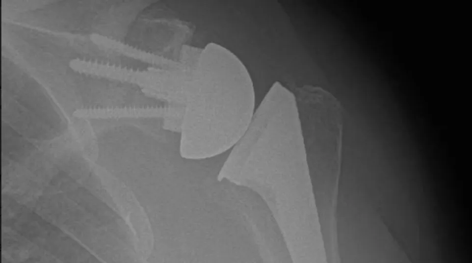 X-ray showing shoulder joint replacement with metal prosthesis and screws in humerus bone.
