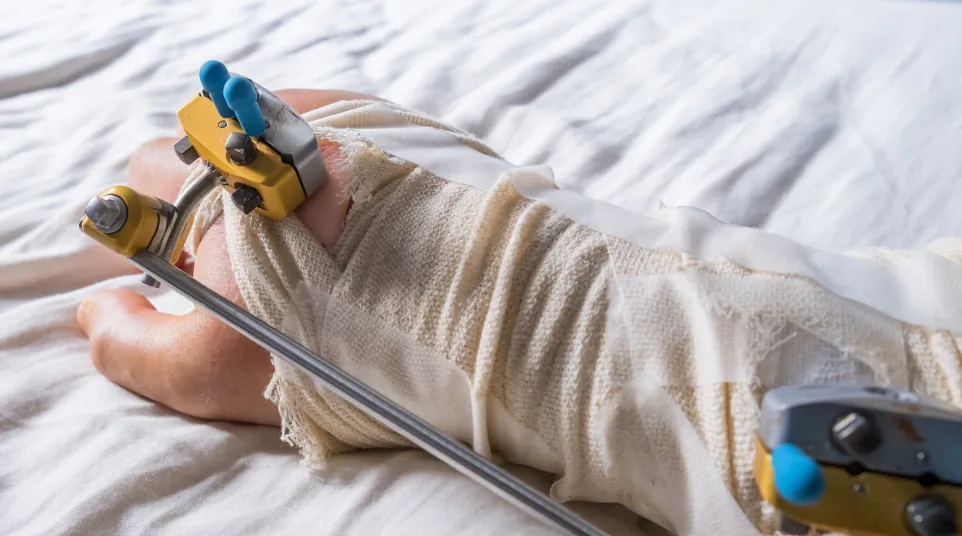 Close-up of a leg in an external fixation cast resting on a bed with visible metal rods and clamps.