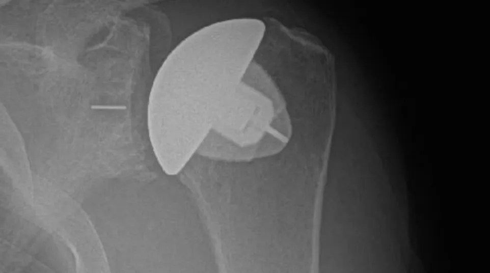 X-ray of shoulder showing a partial shoulder joint replacement implant inside the bone.