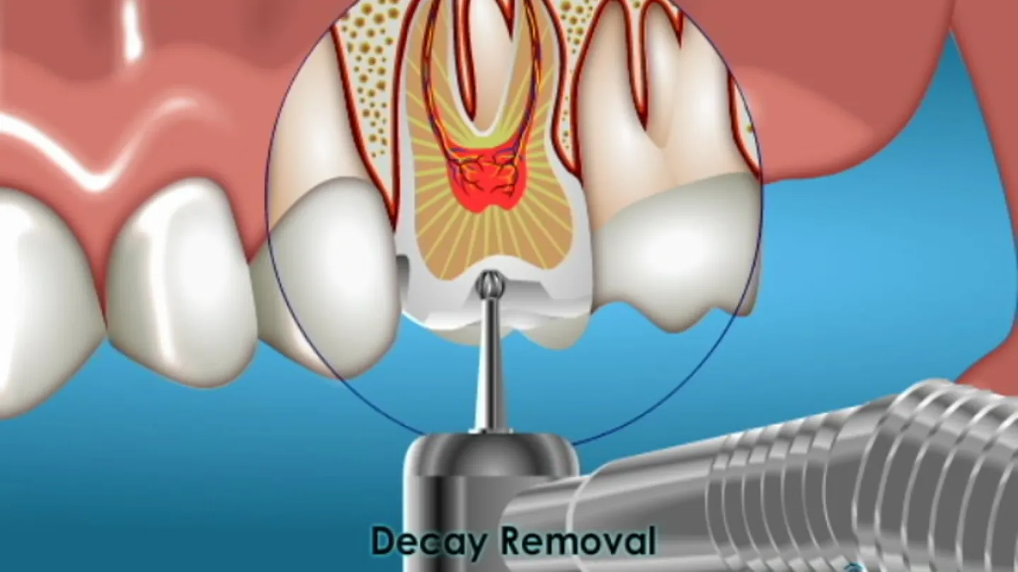 Dental drill removing tooth decay from inside a molar with highlighted inflammation and decay removal label.