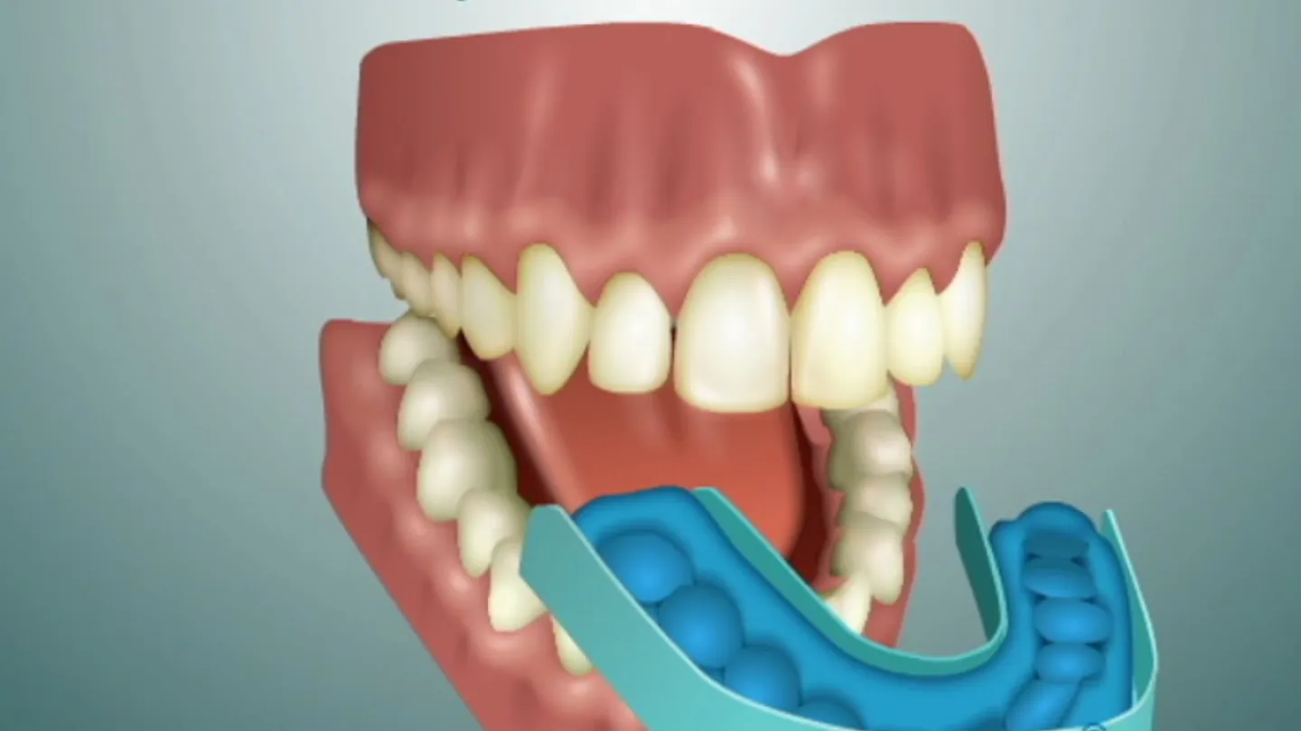 3D illustration of dental impression tray fitting over lower teeth with text Impressions are taken
