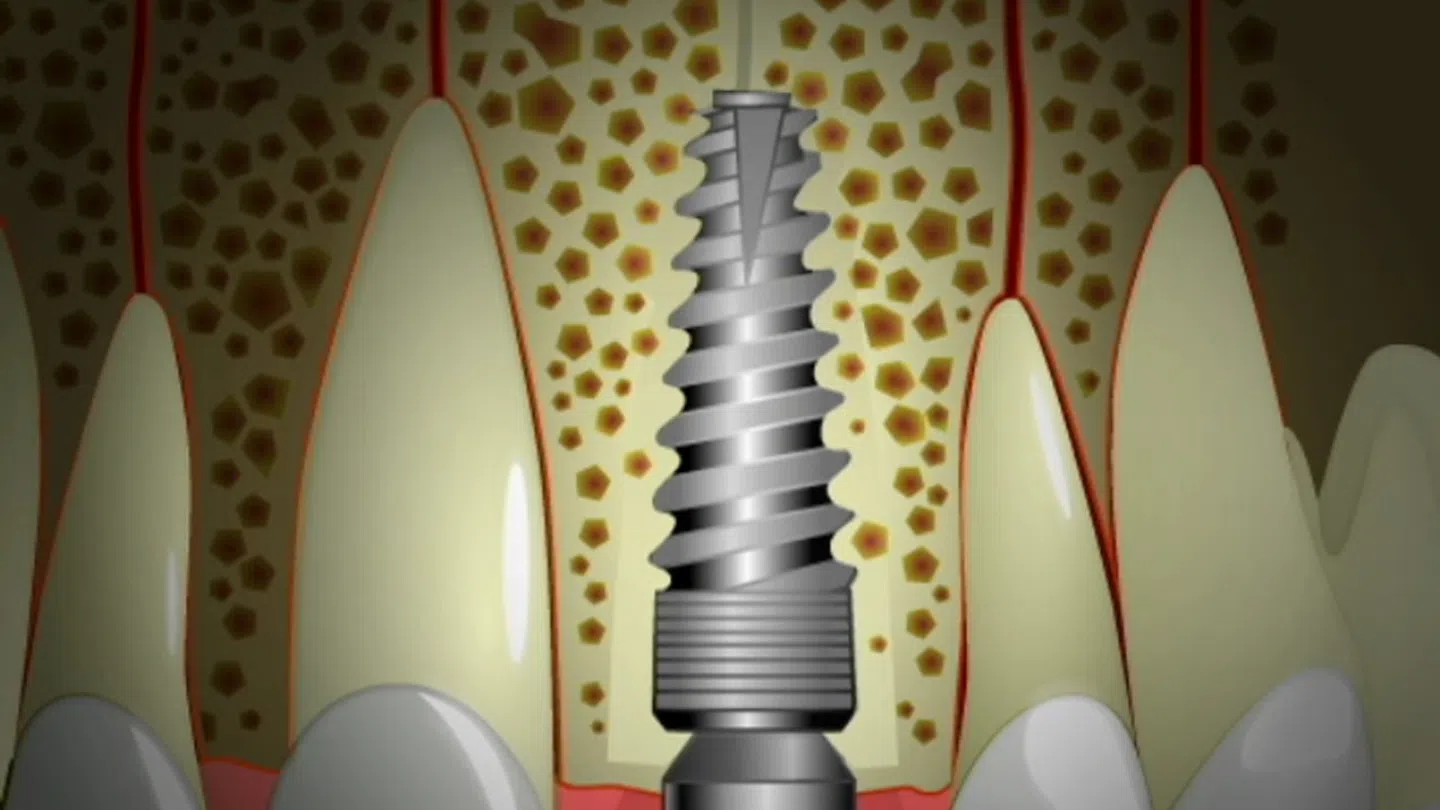 Cross-section of dental implant in jawbone showing stage 2 with surrounding natural teeth and gums.