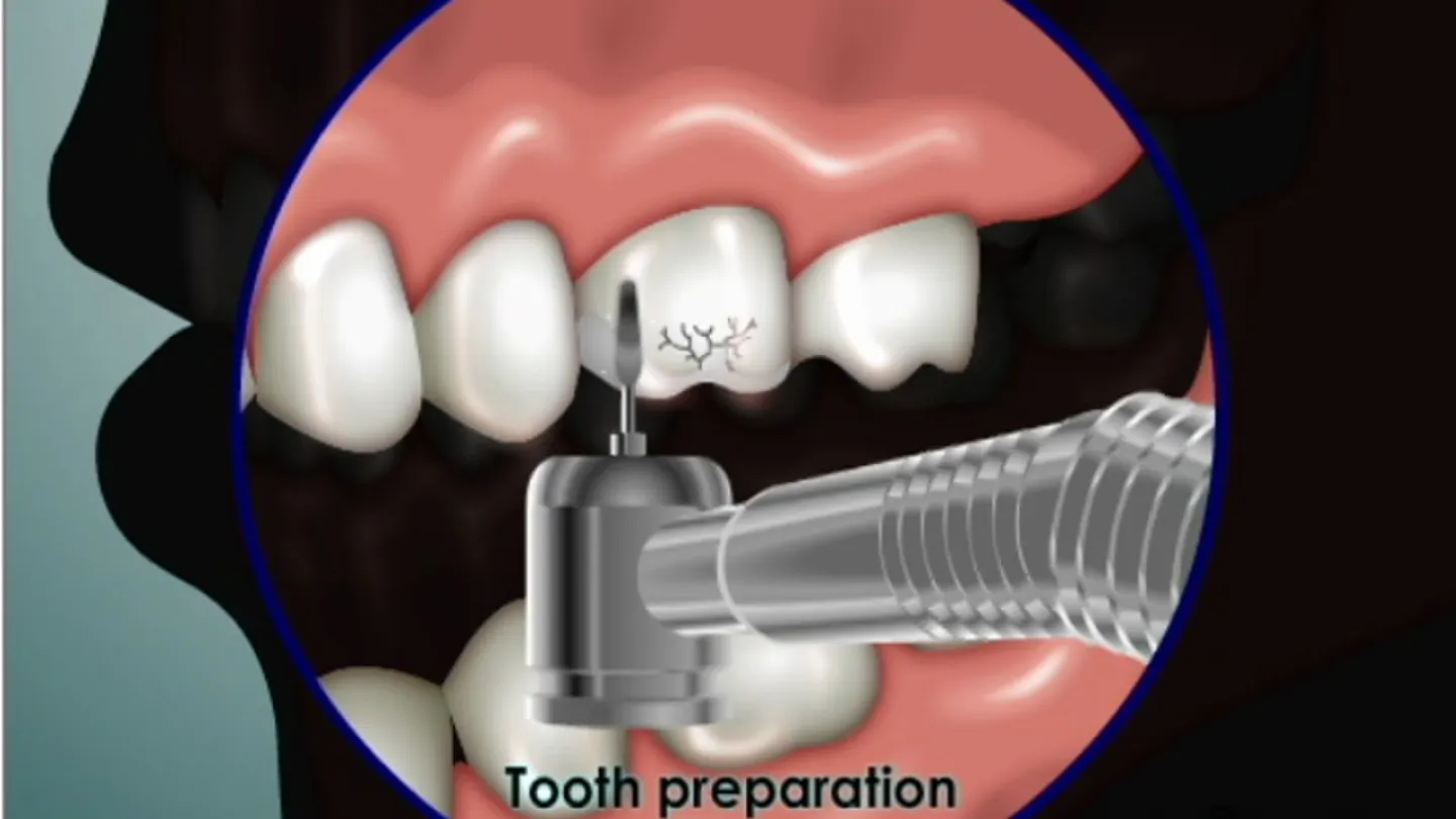 Dental drill used for tooth preparation on a cracked tooth in the upper jaw.