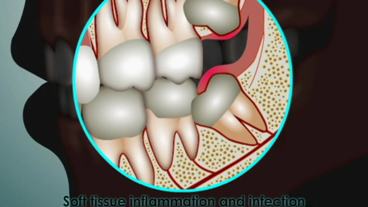 Dental illustration showing soft tissue inflammation and infection around a partially erupted wisdom tooth.