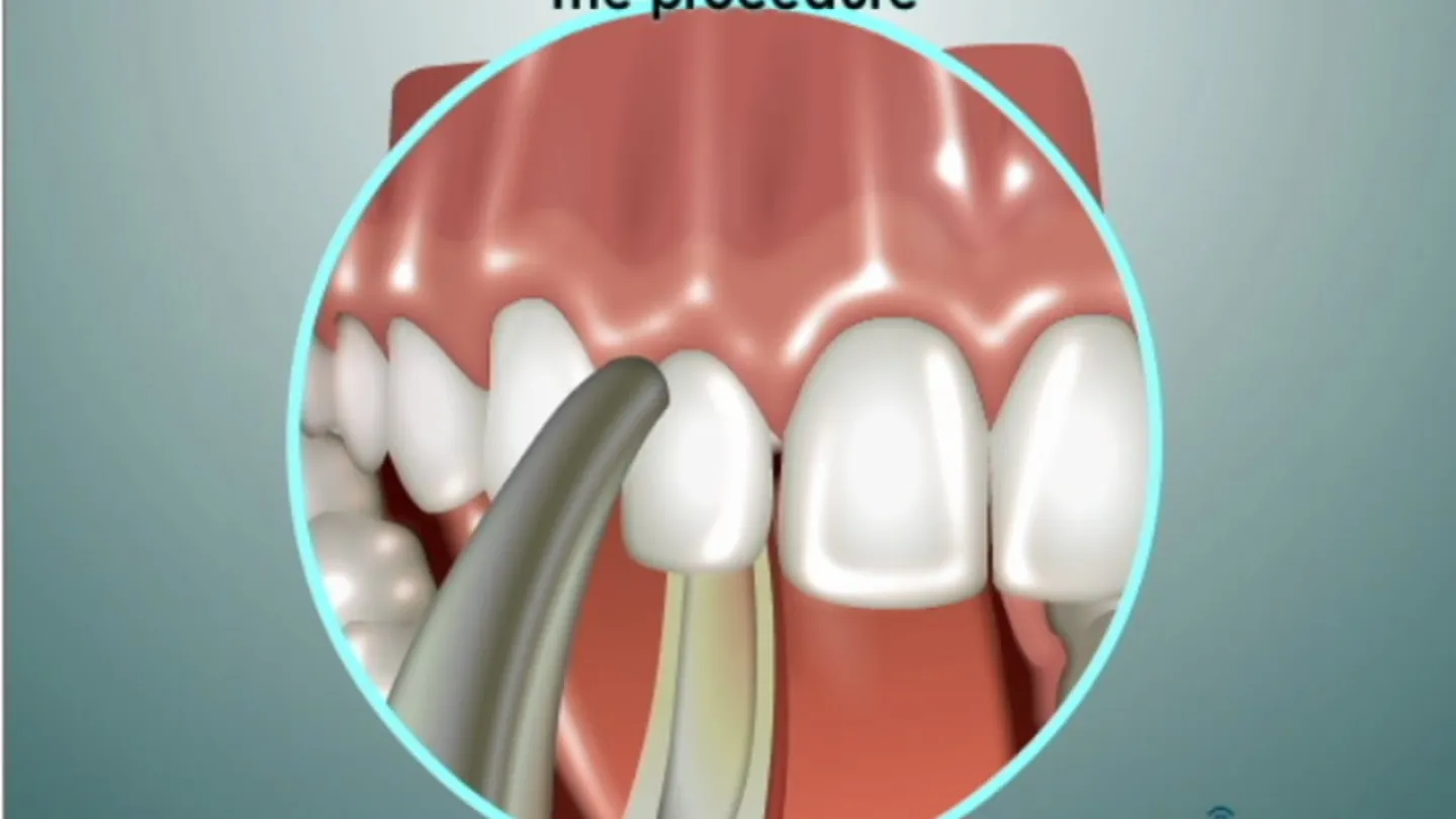 Dental procedure illustration showing a dental tool working on a tooth next to healthy teeth and gums.