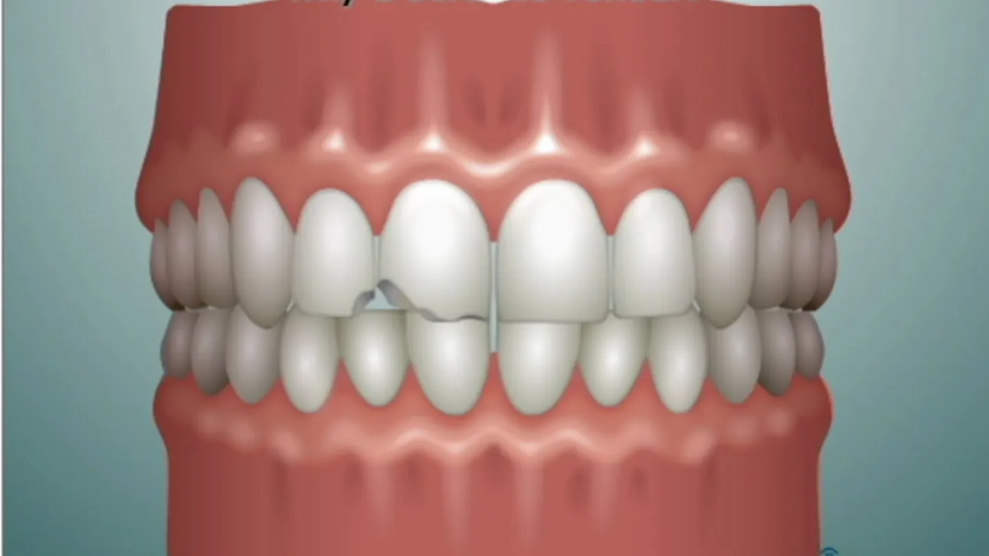 3D dental illustration showing damaged teeth and the benefits of ceramic veneers for restoration.