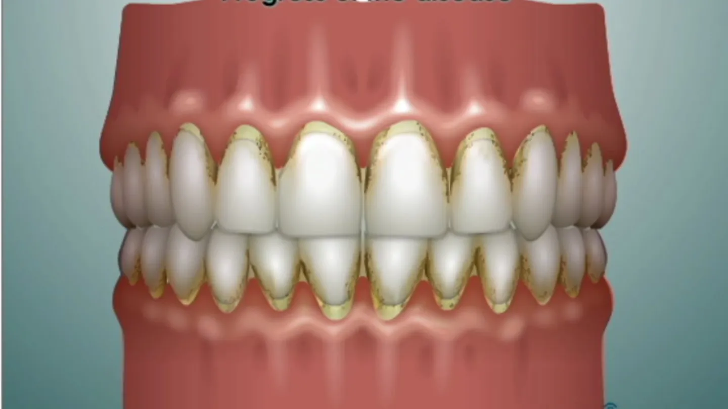 Dental illustration showing progression of gum disease with plaque buildup and inflamed gums around teeth.
