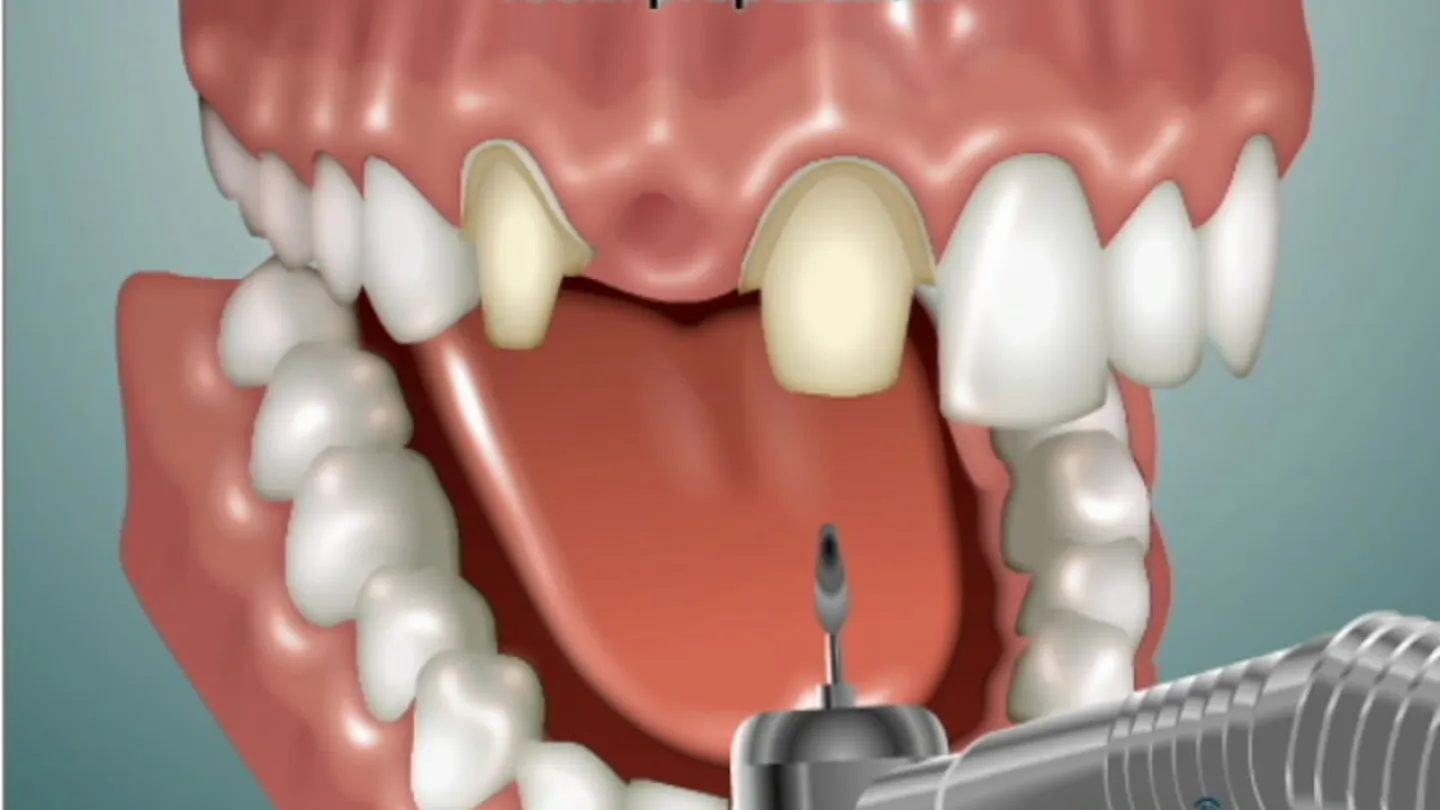 Dental illustration showing tooth preparation with dental drill on upper front teeth for crown placement.
