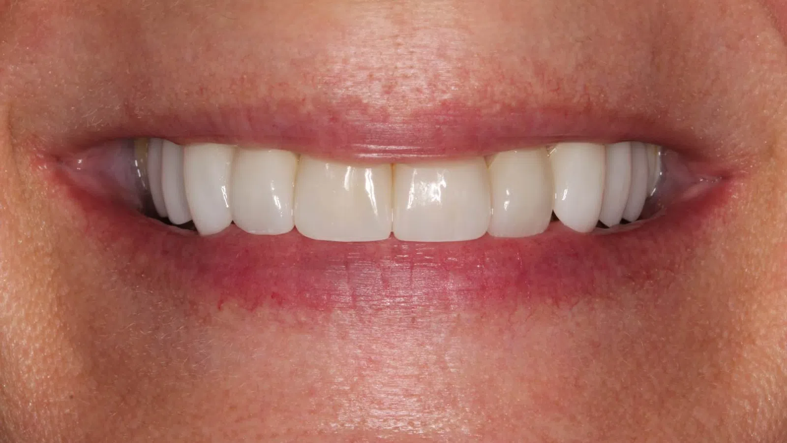 Close-up of a smile showing clean, white, evenly aligned upper teeth and natural lips.