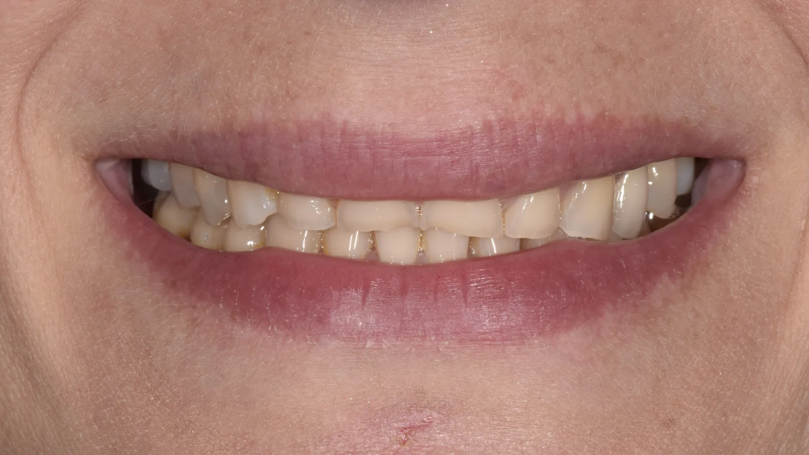 Close-up of a smile showing uneven, discolored teeth with visible dental issues and dry lips.